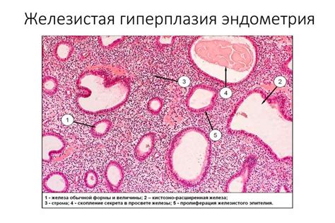 Железистая гиперплазия: основные симптомы