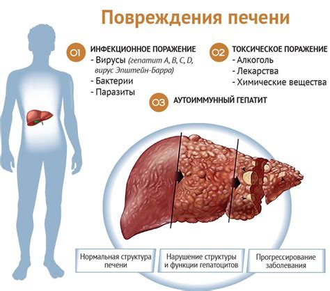 Желтушные заболевания печени