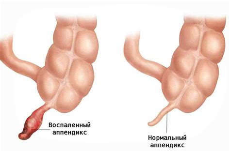 Заболевания аппендикса