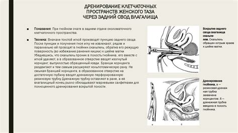 Значение и перспективы дренирования малого таза у женщин