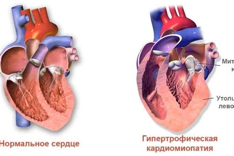 Значение регургитации 1 степени митрального клапана