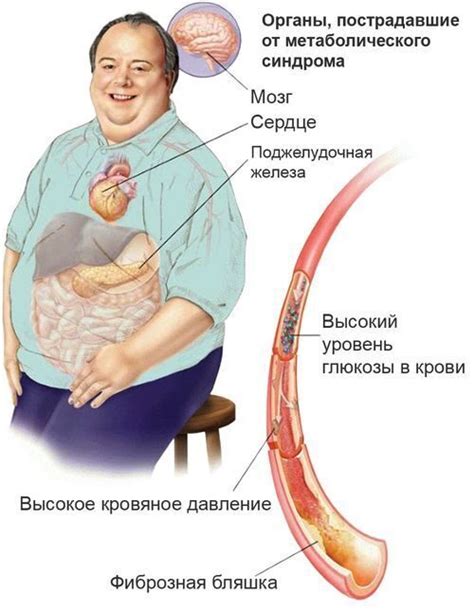 Избыток сахара и метаболический синдром