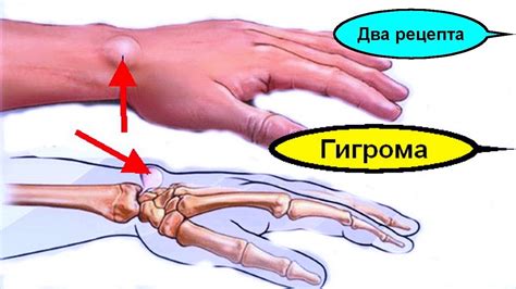 Инновационные методы лечения шишки на запястье