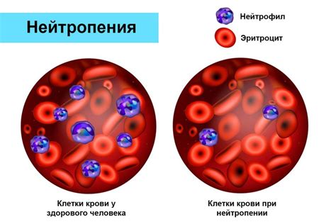 Инфекционные заболевания как причина повышения уровня нейтрофилов