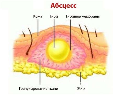 Инфекция и развитие абсцесса