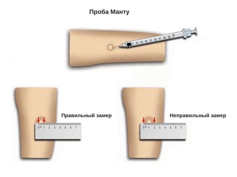 Искажение результатов прививки