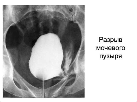 Какие внешние воздействия могут вызвать разрыв мочевого пузыря?