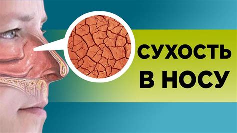 Какие симптомы возникают при сухости в горле и носоглотке?