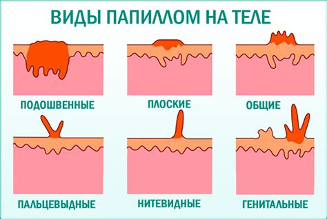 Какую опасность несет содрание папилломы?