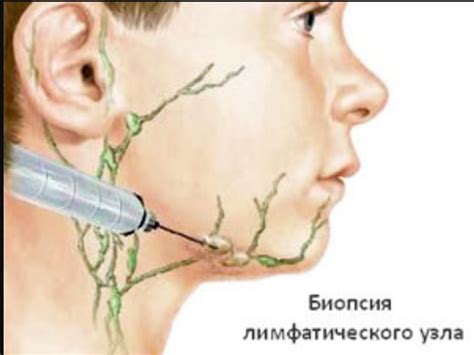 Как определить воспаление лимфоузла