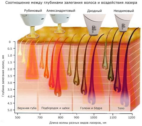 Как правильно наносить гель для лазерной эпиляции?