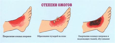 Как предотвратить шрам при обработке ожога