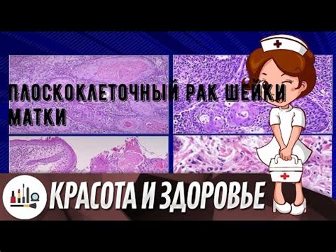 Как проводится диагностика патологии плоского эпителия через цитограмму?