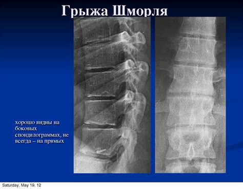 Как проводится диагностика узуративных дефектов в телах позвонков?