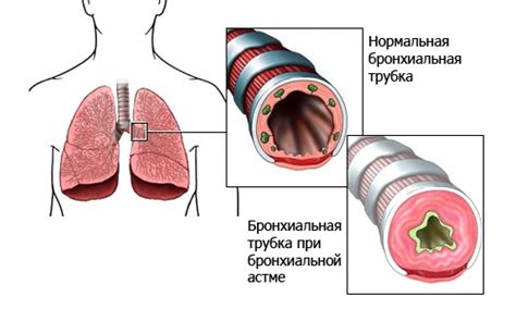 Как работает бронхиальная система