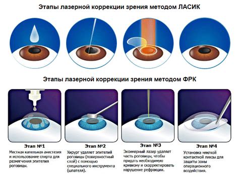 Как работает метод Ласик?