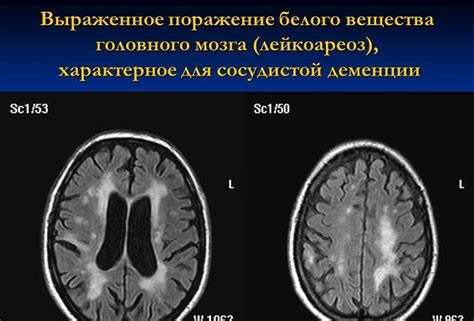 Как распознать лейкоареоз головного мозга