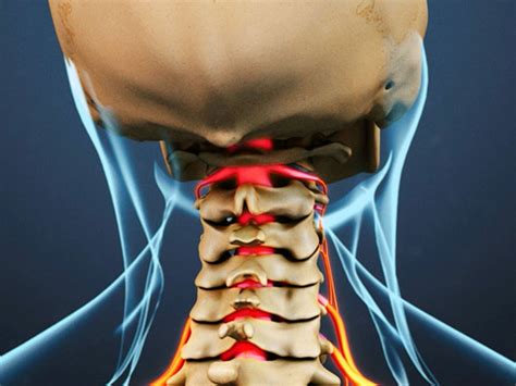 Как самостоятельно снять защемление шейного нерва