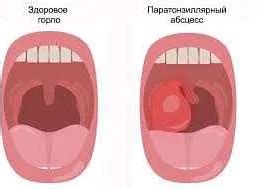 Когда следует обратиться к врачу при жжении в горле после рвоты