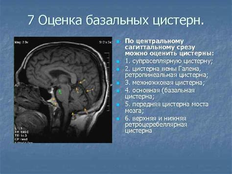 Консультация специалиста по расширению базальных цистерн головного мозга