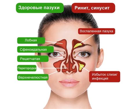 Корки соплей: как эффективно и безопасно очистить носовые пазухи