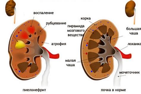 Левая почка