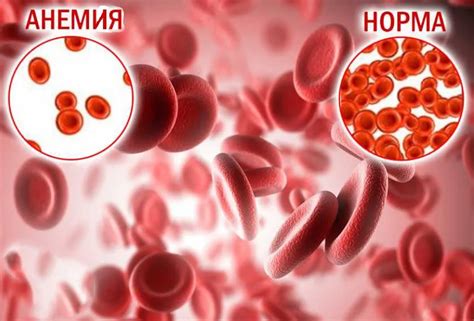 Лечение анемии и низкого уровня железа