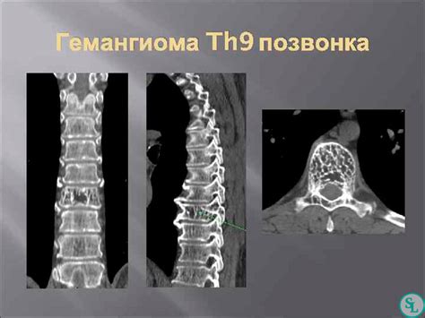 Лечение гемангиомы Th9 позвонка