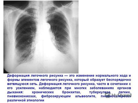 Лечение деформации легочного рисунка на рентгене