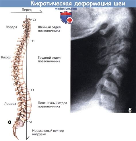 Лечение кифотической установки шейного отдела позвоночника