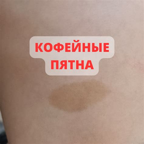 Лечение коричневого пятна на локте