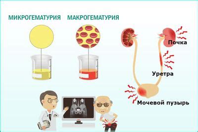 Лечение макрогематурии у мужчин пожилого возраста