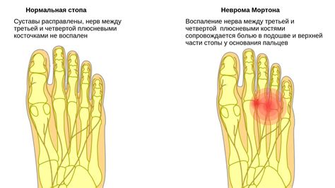 Лечение немоты пальцев на правой ноге