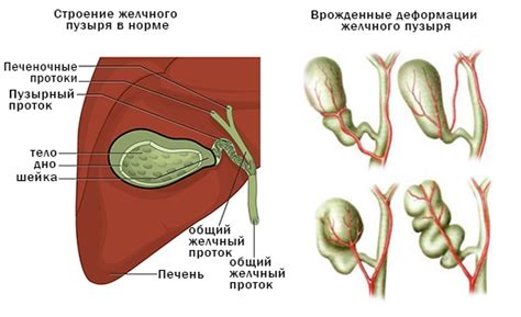 Лечение перегиба в шейке желчного пузыря