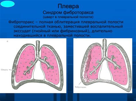 Лечение плевропульмональных спаек в легких