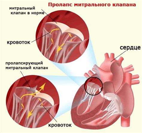 Лечение пролапса митрального клапана без нарушения гемодинамики