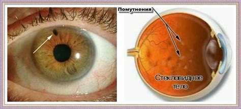 Лечение темных точек перед глазами