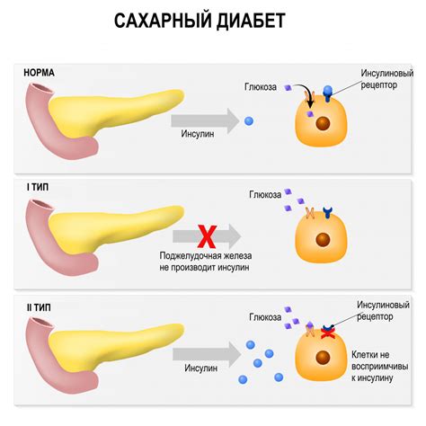 Манифест при диабете 1 типа: основные черты