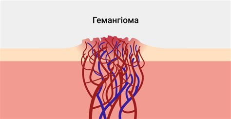 Методы диагностики и лечения гемангиомы