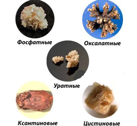 Методы диагностики камней и песка в почках