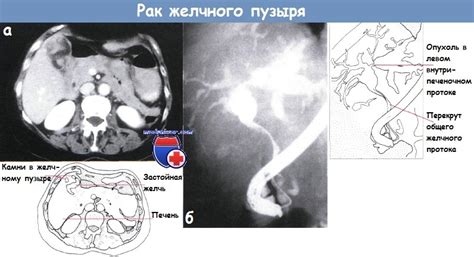 Методы контрастной картографии желчного пузыря