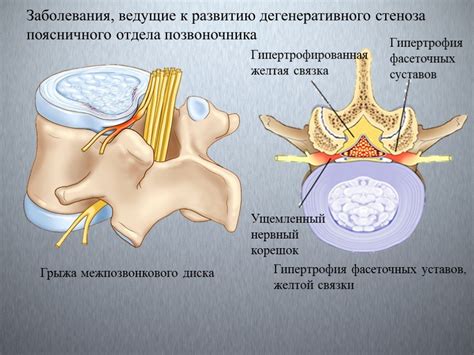 Методы лечения и профилактика гипертрофии желтых связок