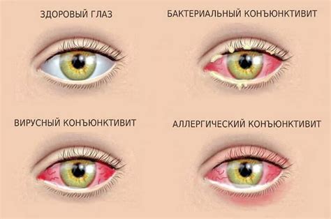 Методы лечения коньюктивита у детей до года