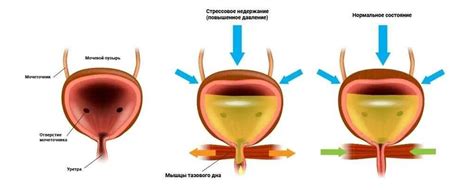 Методы лечения ночного недержания мочи