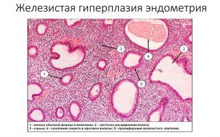 Методы лечения простой железистой гиперплазии