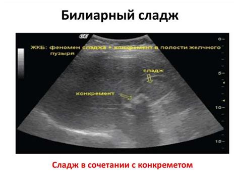 Методы лечения сладжа в желчном пузыре