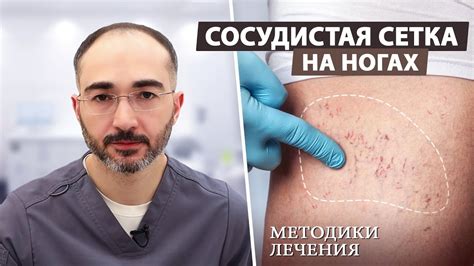 Методы лечения сосудистых звездочек на ногах