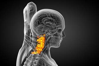 Методы лечения спондилеза шейного отдела