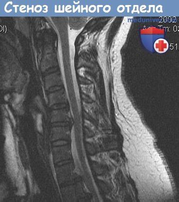 Методы лечения стеноза шейного отдела позвоночника