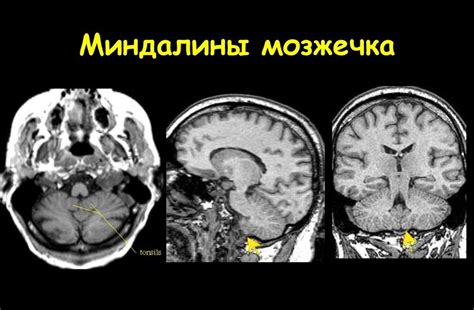 Миндалины мозжечка в анатомии человека